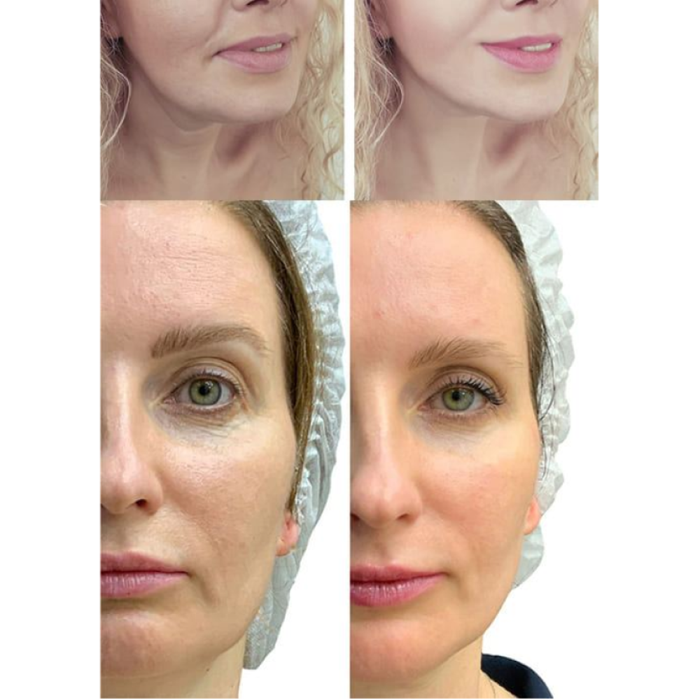 Mikroprądowy masażer do liftingu twarzy Skin Lifting 7.0 White – EMS, LED (Japonia)