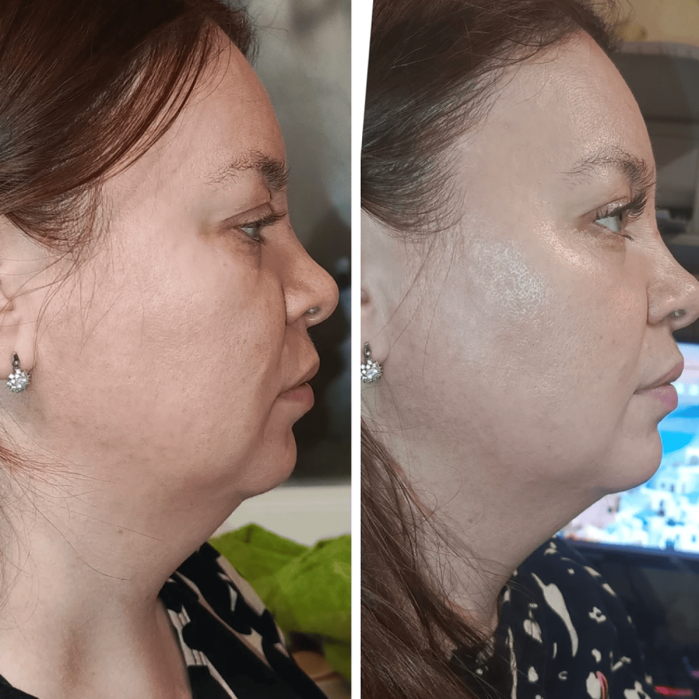 Mikroprądowy masażer do liftingu twarzy RF Skin Lifting 7.0 Pink – EMS, LED (Japonia)